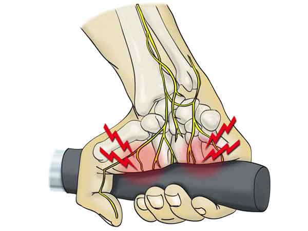 Tendinitis extensores muneca tratamiento
