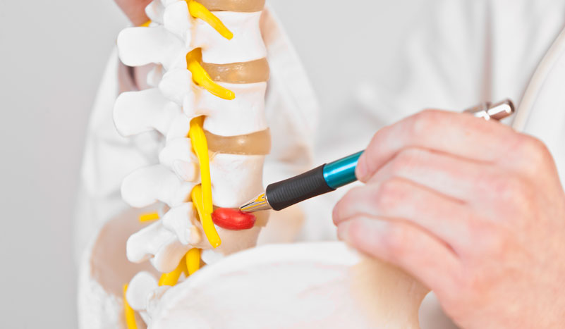 Dieta para persona con hernia discal