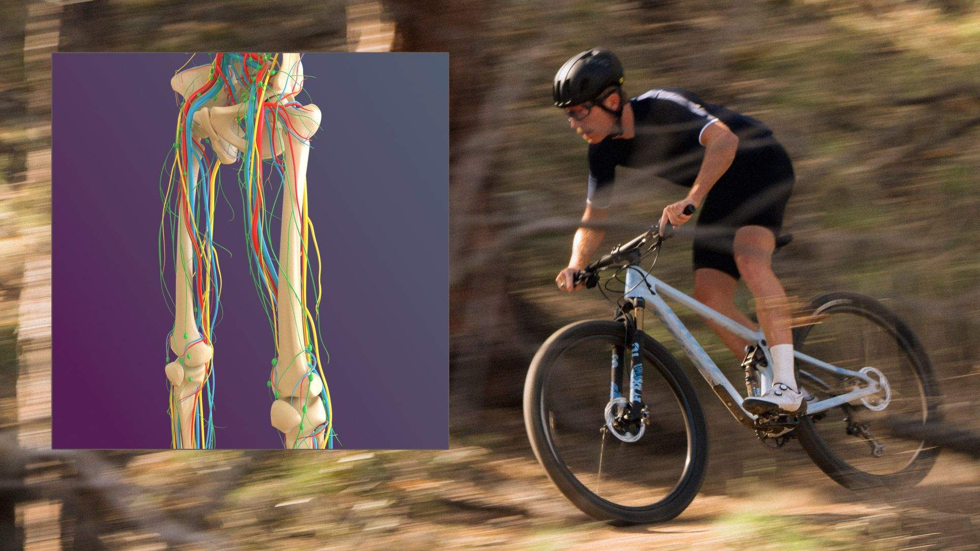 Endofibrosis, una lesión no tan rara en ciclistas Endofibrosis, una lesión no tan rara en ciclistas