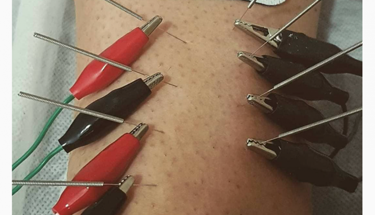 Electroterapia