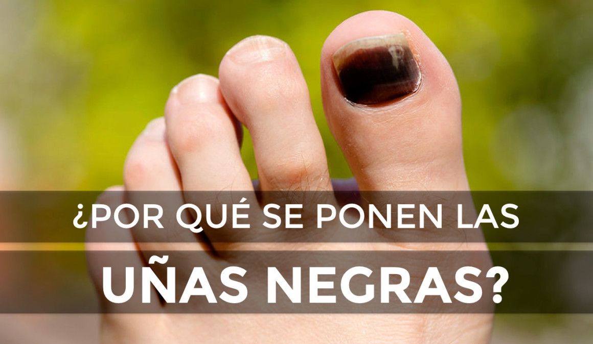 ¿Por qué se ponen las uñas negras? ¿Por qué se ponen las uñas negras?