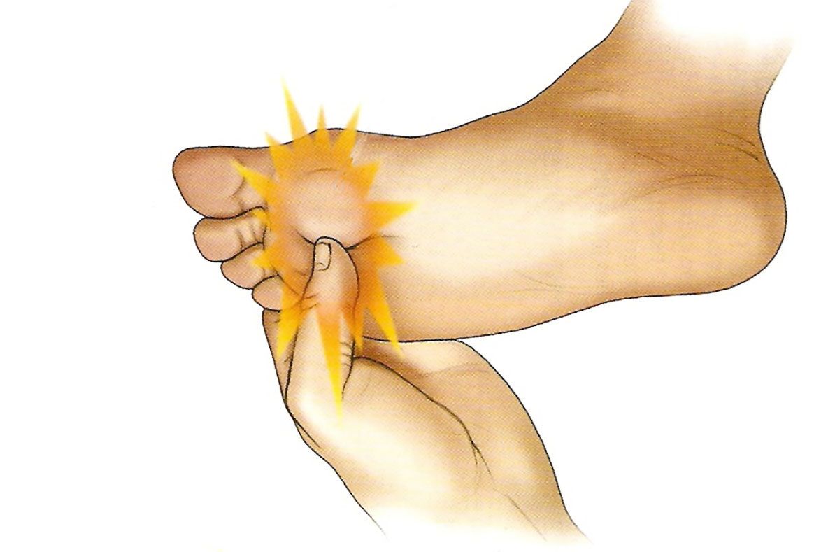 Fractura metatarsiana