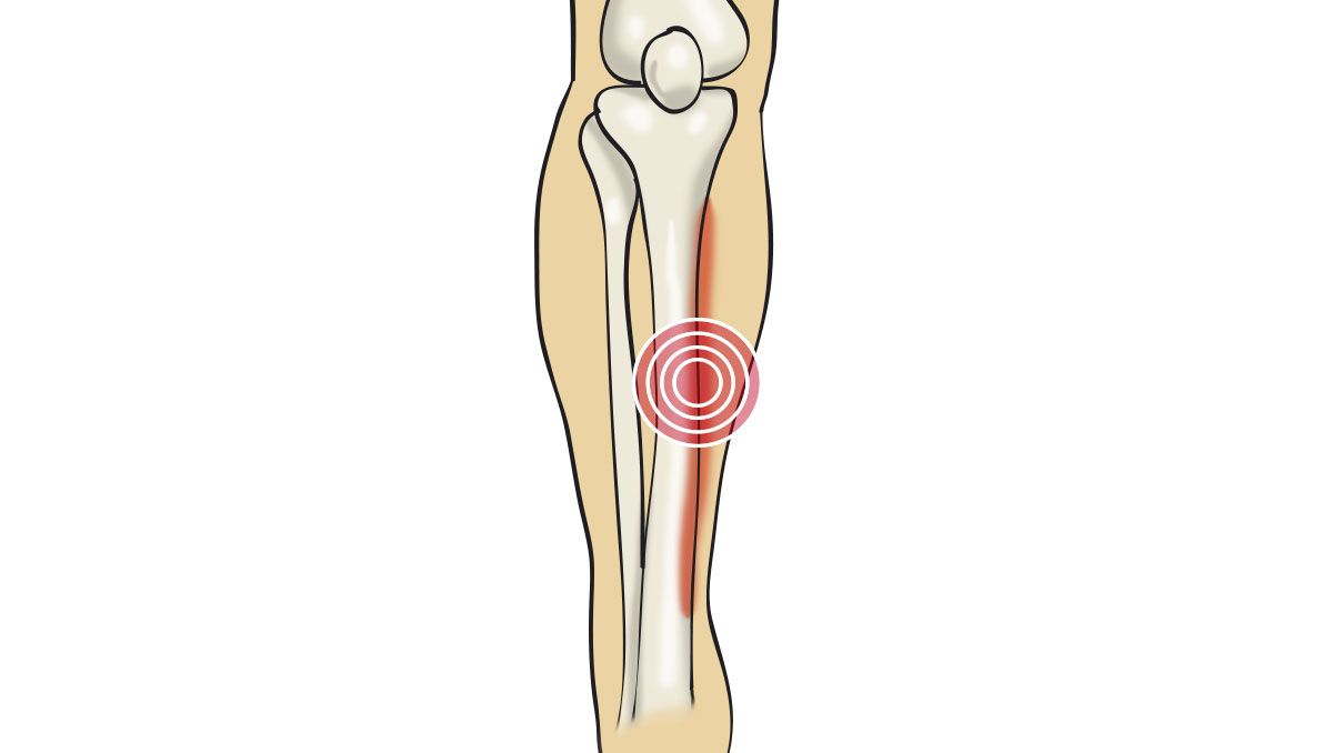 Periostitis tibial