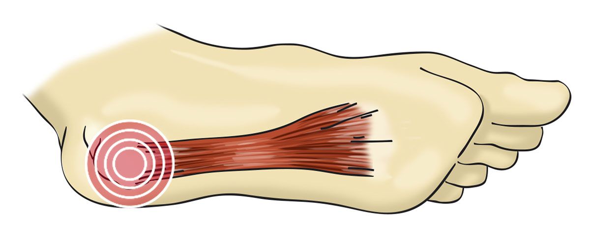 Fascitis plantar