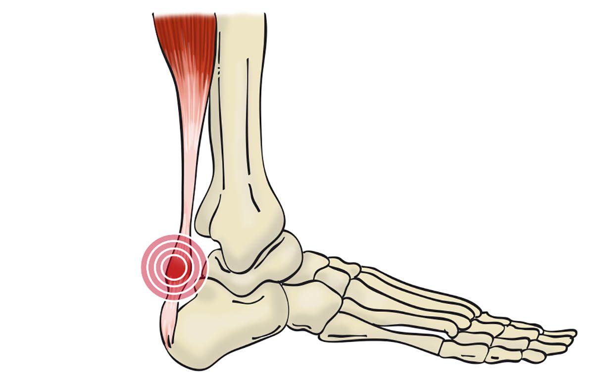Tendinitis aquilea