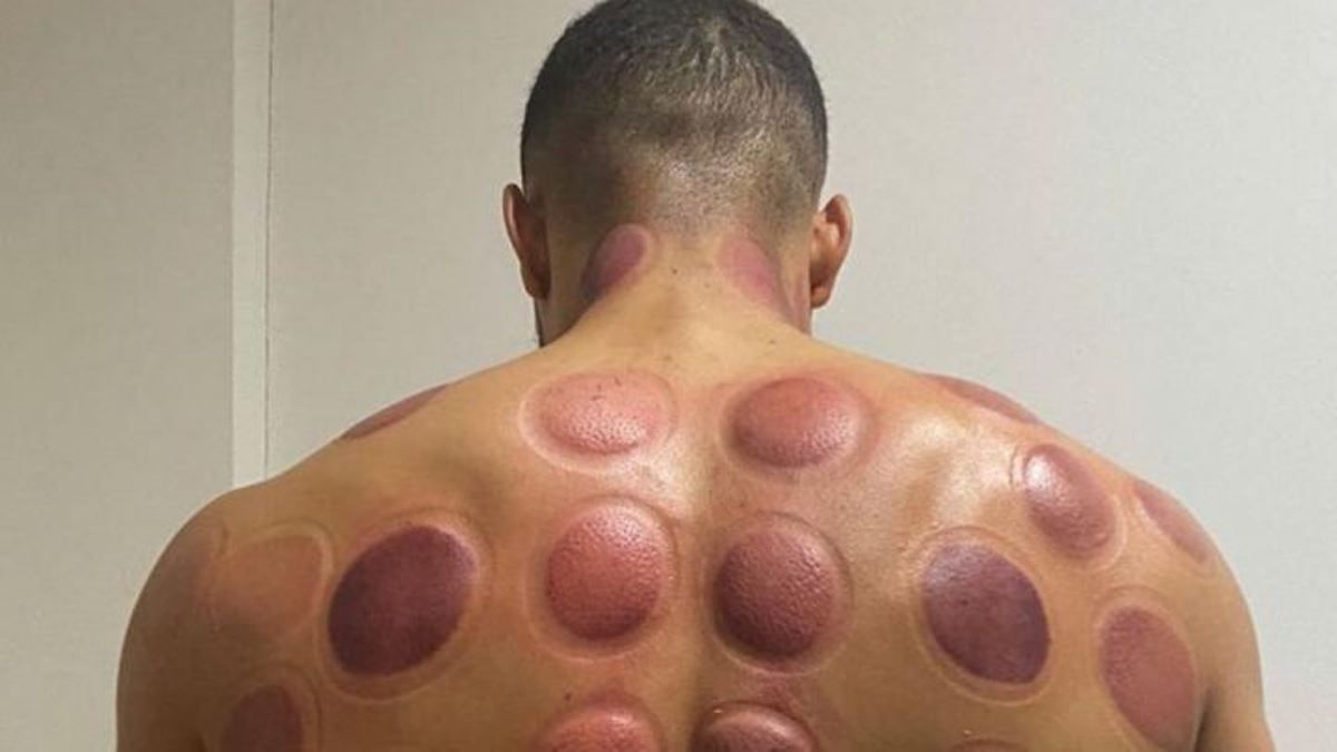 El efecto del tratamiento del "cupping" sobre la espalda del futbolista del Villareal Danjuma