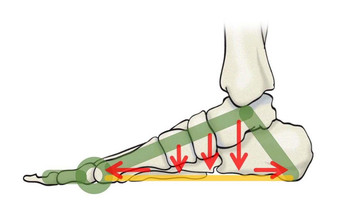 Tratar la fascitis plantar (1) Tratar la fascitis plantar (1)