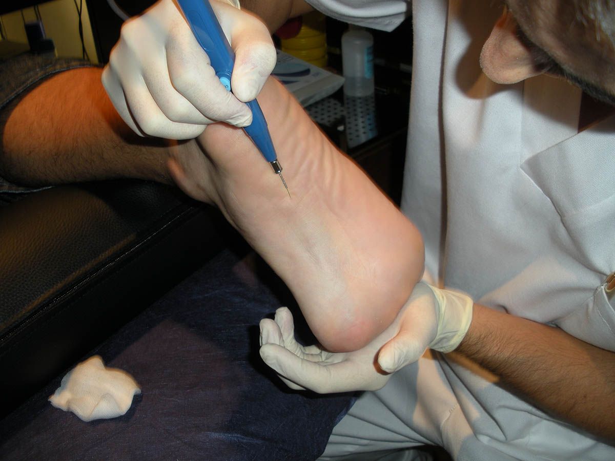 Tratar la fascitis plantar (4) Tratar la fascitis plantar (4)