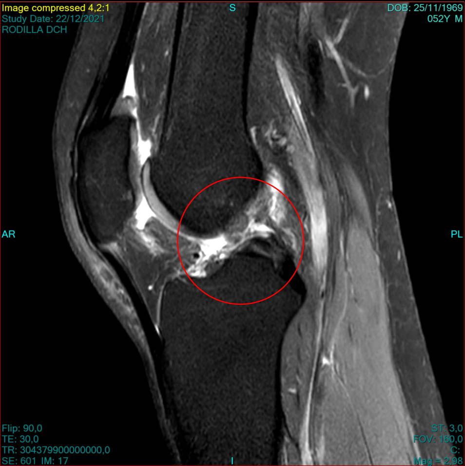 Ligamento LCA roto con calcificaciones Ligamento LCA roto con calcificaciones