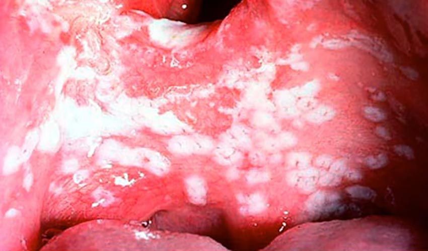 oral thrush 8col