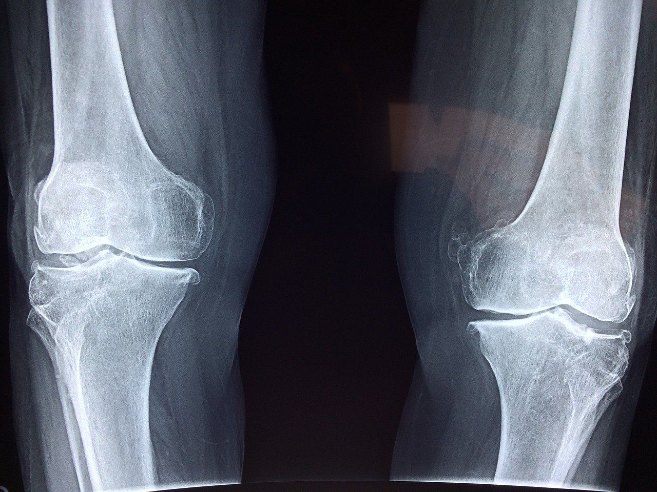 knee ga505b3f05 1280 knee ga505b3f05 1280