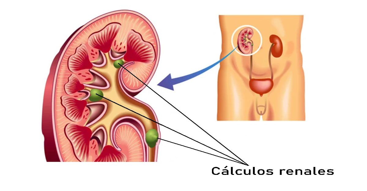 Cálculos renales