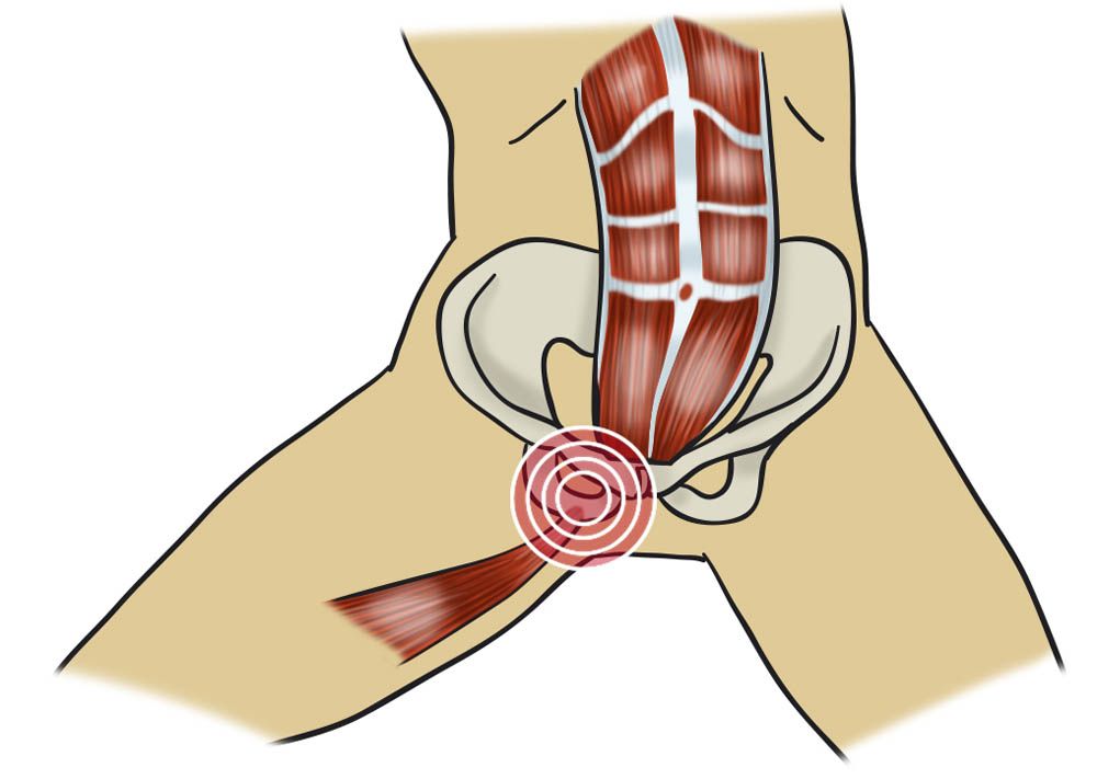 5e4277950ce69468378b4579 tengo pubalgia ejercicios prevenir tratar 5e4277950ce69468378b4579 tengo pubalgia ejercicios prevenir tratar