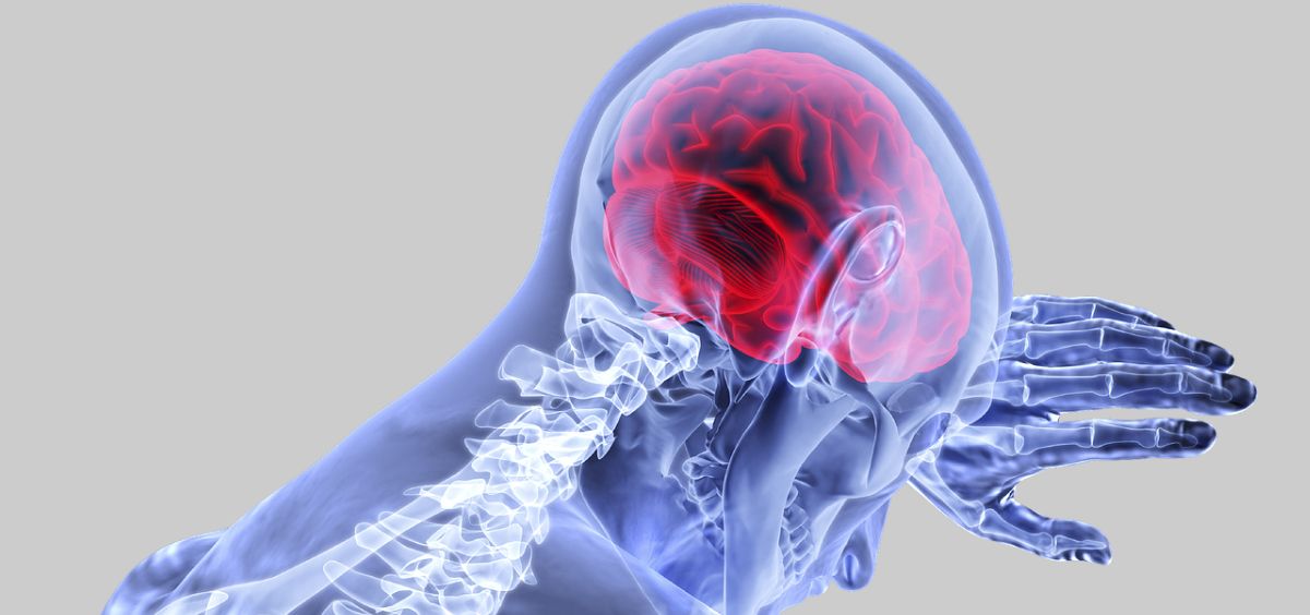 Conocer qué es un ictus nos ayudará a prevenirlo y tratarlo a tiempo