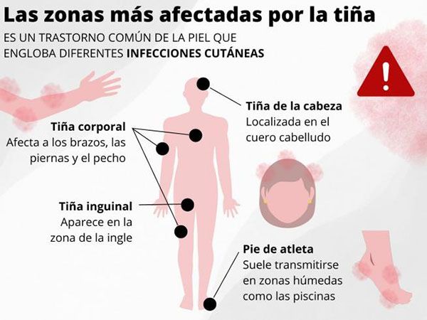 Áreas afectadas por el contagio de tiña Áreas afectadas por el contagio de tiña