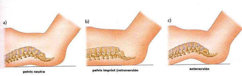 Pelvis neutra Pelvis imprint Pelvis neutra Pelvis imprint