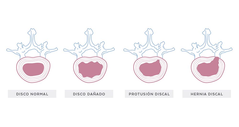 Tipos de lesiones discales Tipos de lesiones discales