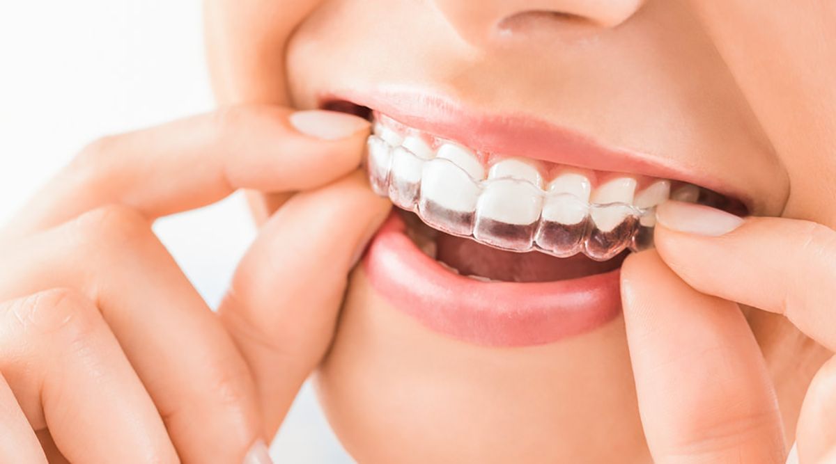 Alineadores dentales ¿se puede comer y beber con ellos?