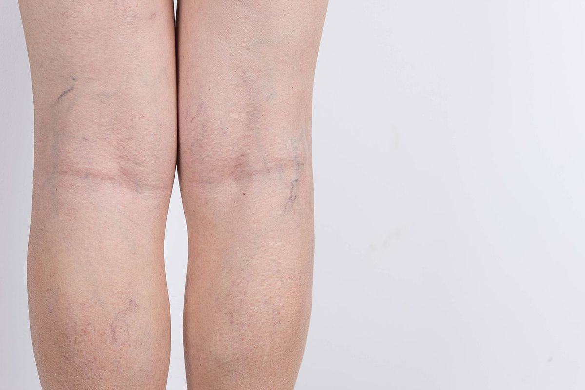 ¿Qué son y por qué aparecen las varices?