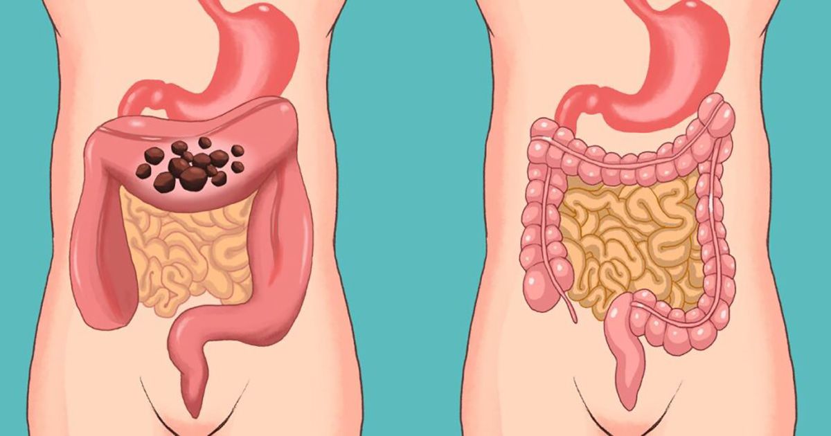 Limpieza intestinal profunda con agua y sal a través del yoga