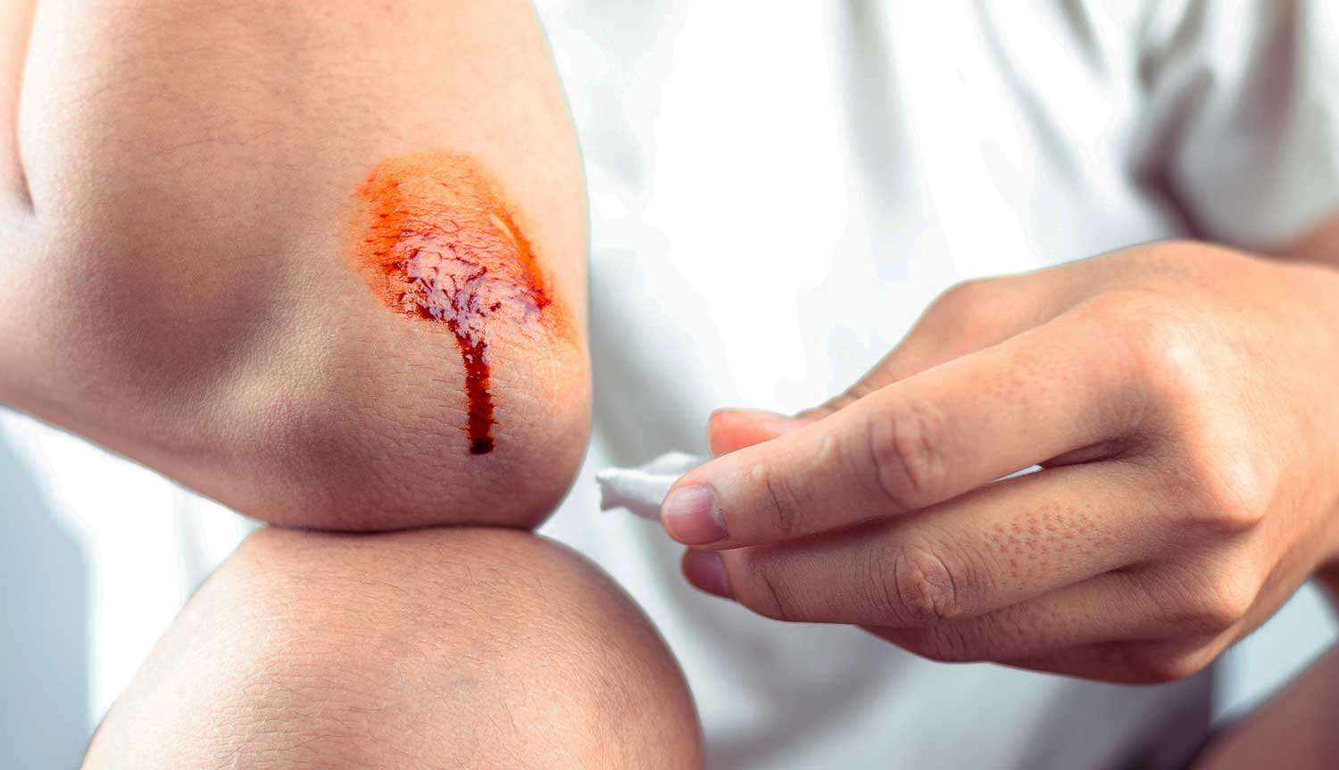 Protegiendo una herida con povidona yodada (Foto: iStock)