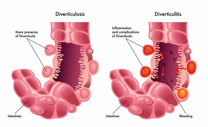 Así se visualiza la diverticulosis Así se visualiza la diverticulosis