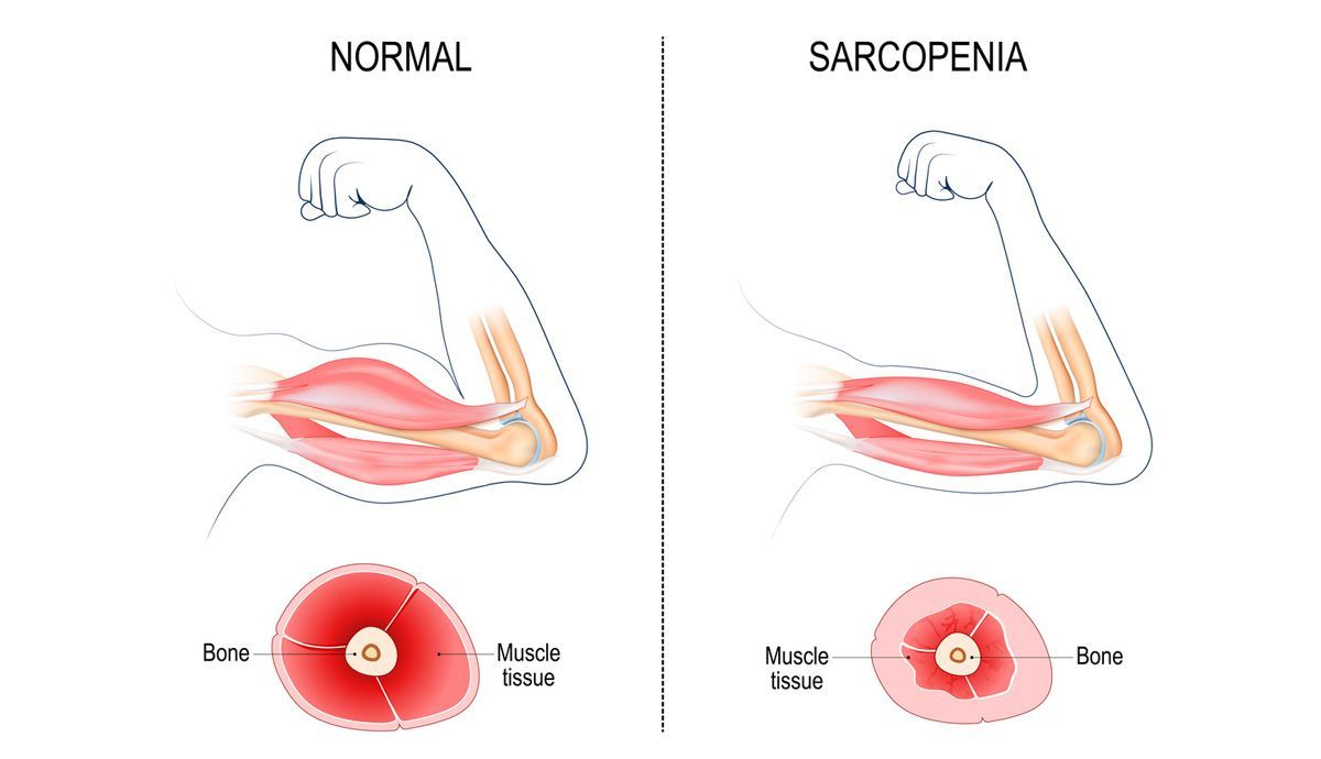 Qué es la sarcopenia y qué podemos hacer para evitarla Qué es la sarcopenia y qué podemos hacer para evitarla
