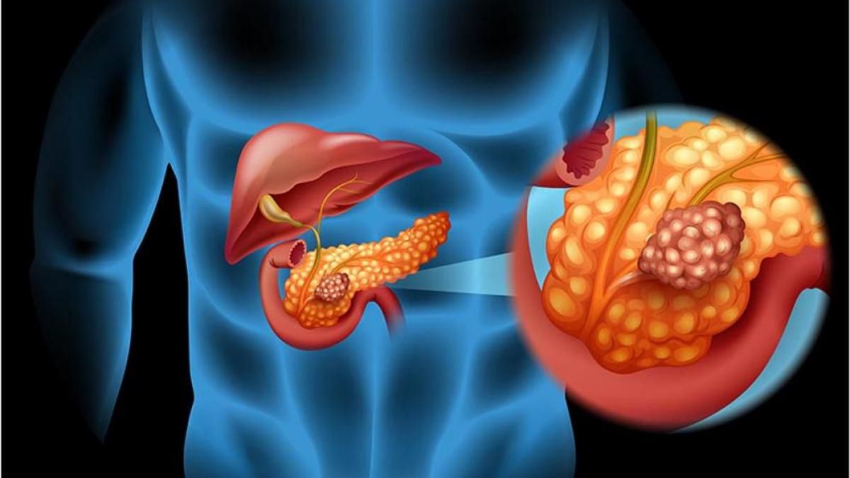 Un gran avance contra el cáncer de páncreas  el maleato de perhexilina