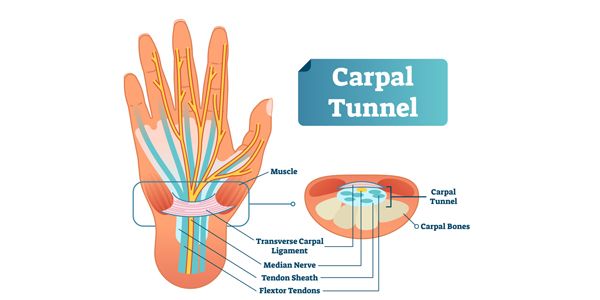 ¿Trabajas con las manos? Conoce el síndrome del túnel carpiano