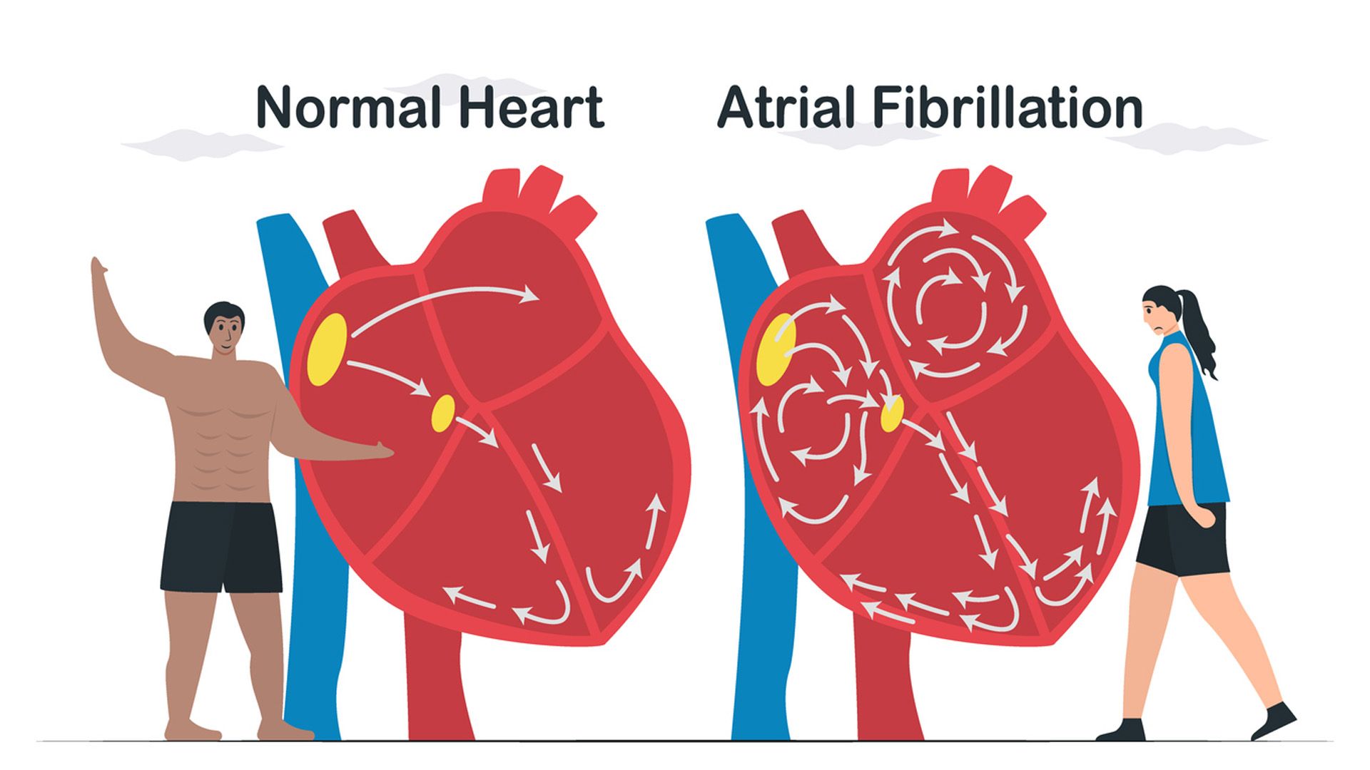 ¿Sabes cómo suena un corazón con fibrilación auricular?