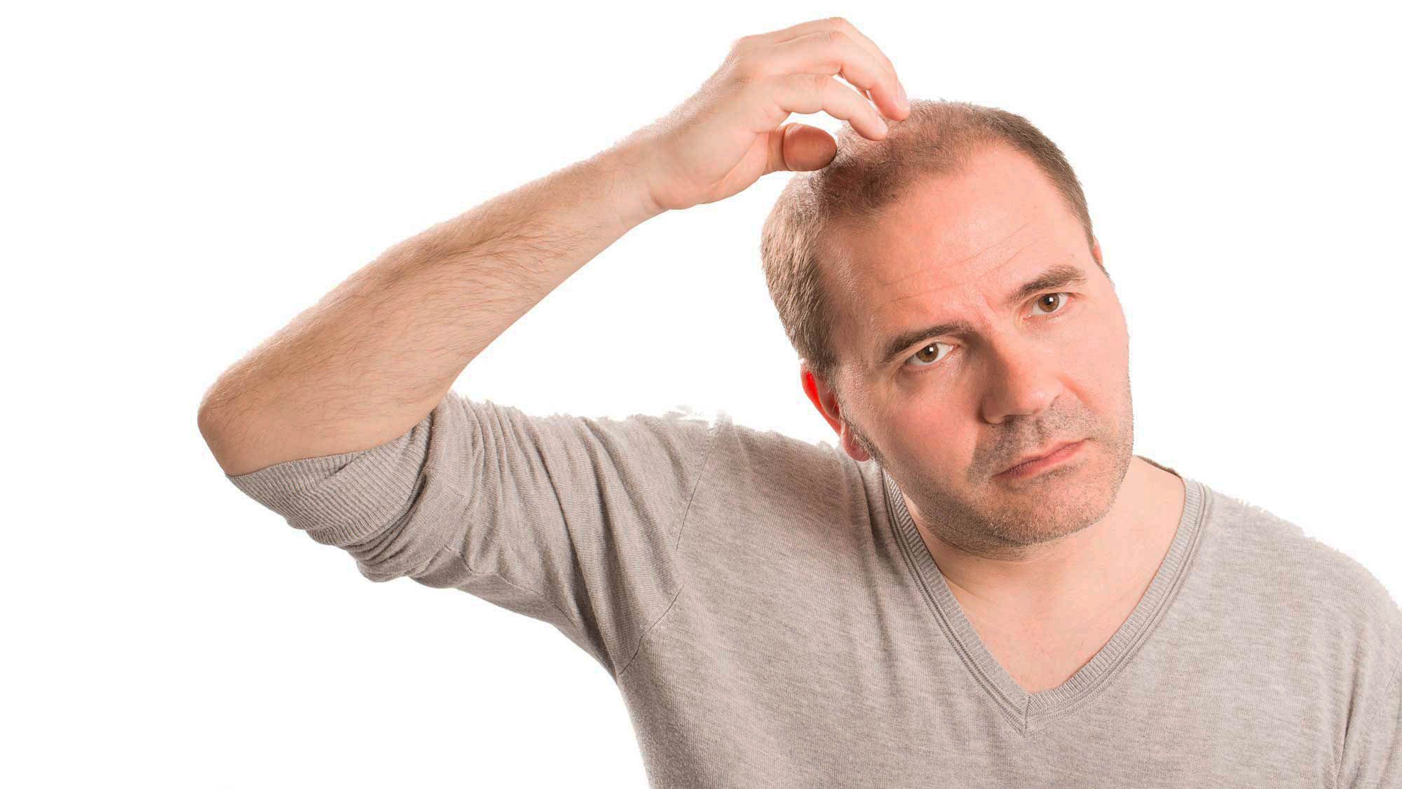 Todo lo que necesitas saber sobre el injerto capilar (Foto: iStock)