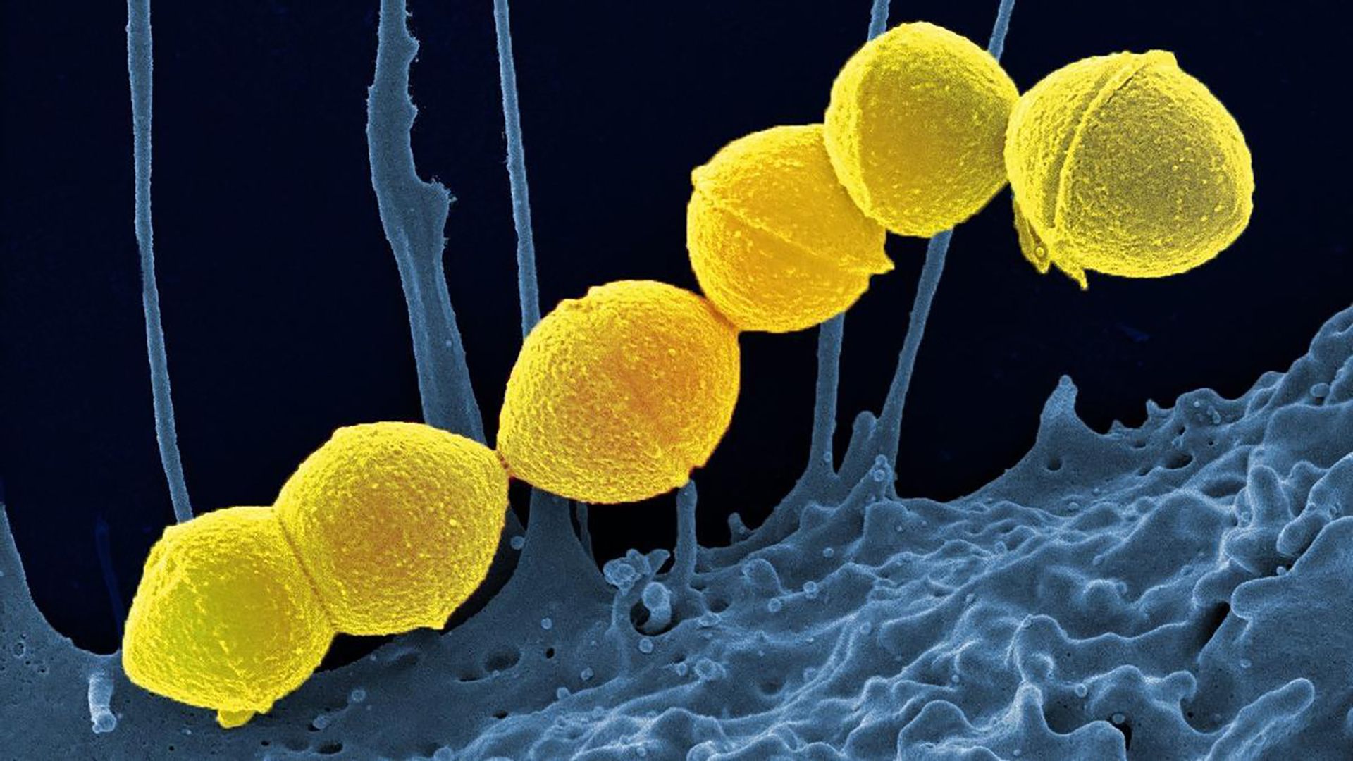Aumento de infecciones por la conocida %22bacteria carnívora%22. Riesgos y soluciones
