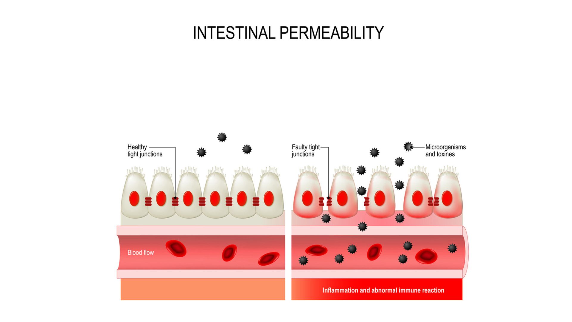 Qué es el intestino permeable