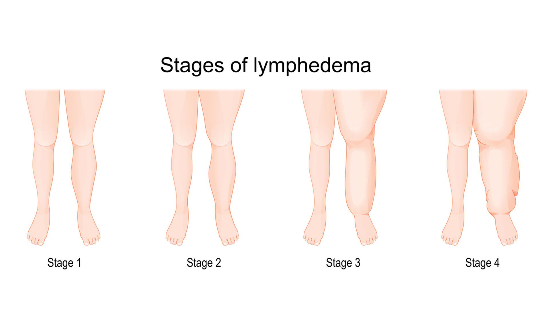 ¿Es recomendable hacer ejercicio para el linfedema?