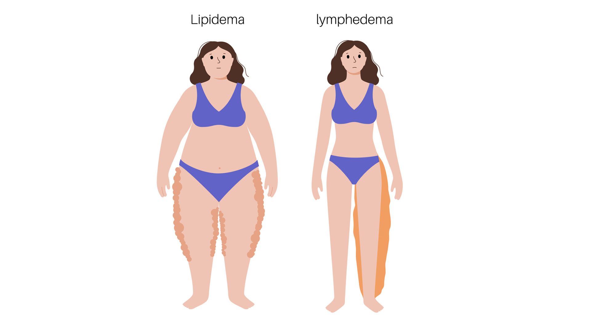 ¿Conoces las diferencias entre lipedema y linfedema?