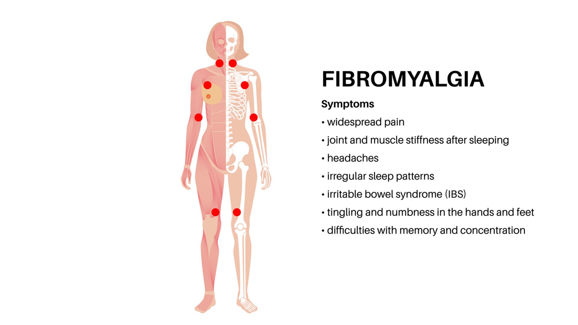 Avances en la investigación en fibromialgia