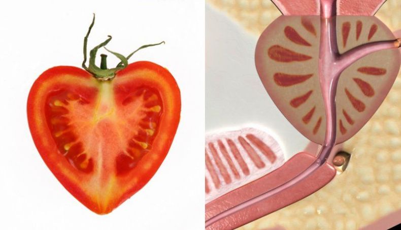 Tomate y próstata Tomate y próstata