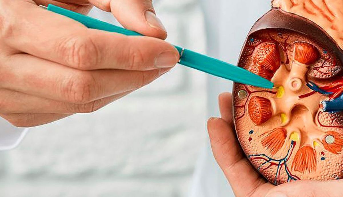 Así podemos evitar las piedras en los riñones