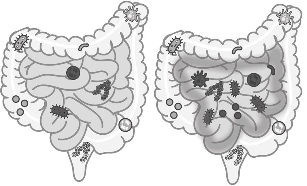 Sistema Digestivo Sano vs Sistema Digestivo con SIBO Sistema Digestivo Sano vs Sistema Digestivo con SIBO