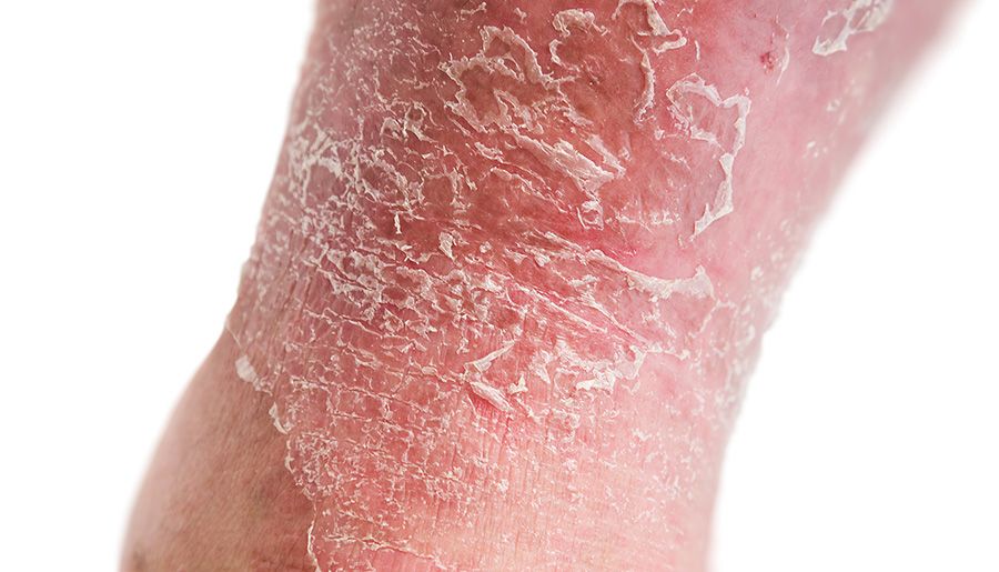 La psoriasis no solo afecta a la piel: también puede influir en la vida sexual