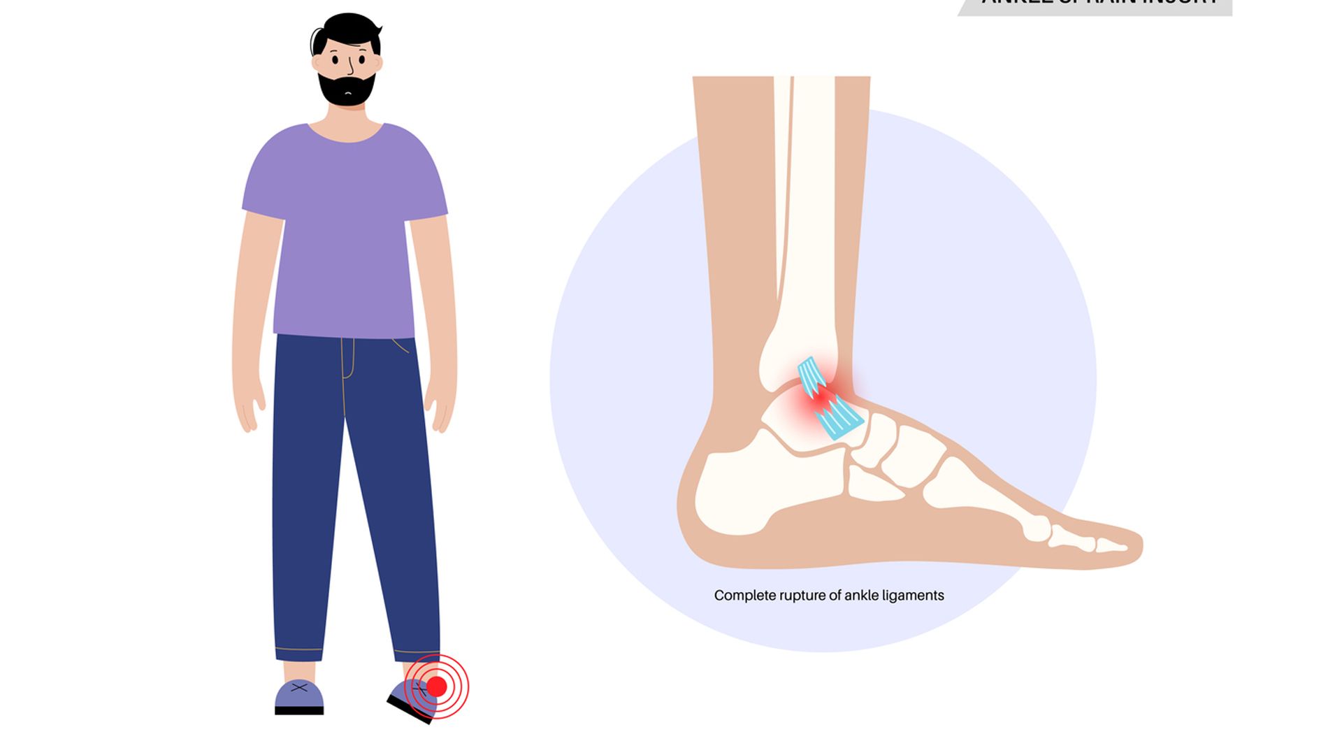 Impingement, la lesión que aparece cuando un esguince de tobillo se cura mal