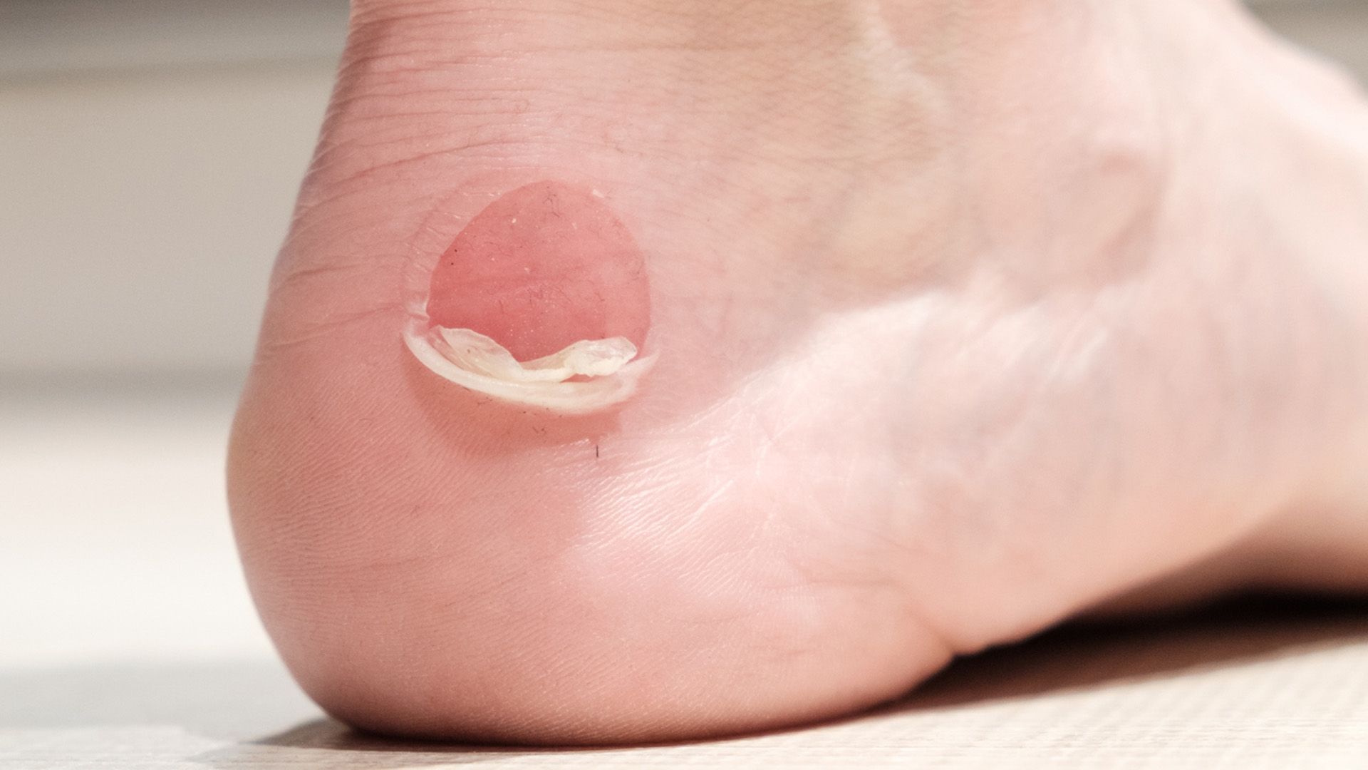 Ampollas en el pie del corredor