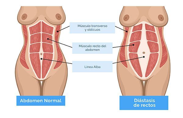 Diástasis abdominal