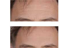 Imagen de Galeria de Safetox: La alternativa al botox en tu propia casa (con vídeo demostrativo)