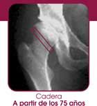 Imagen de Galeria de Osteoporosis, una epidemia silenciosa