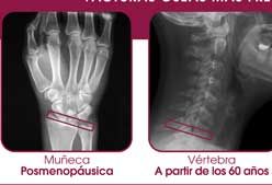Imagen de Galeria de Osteoporosis, una epidemia silenciosa