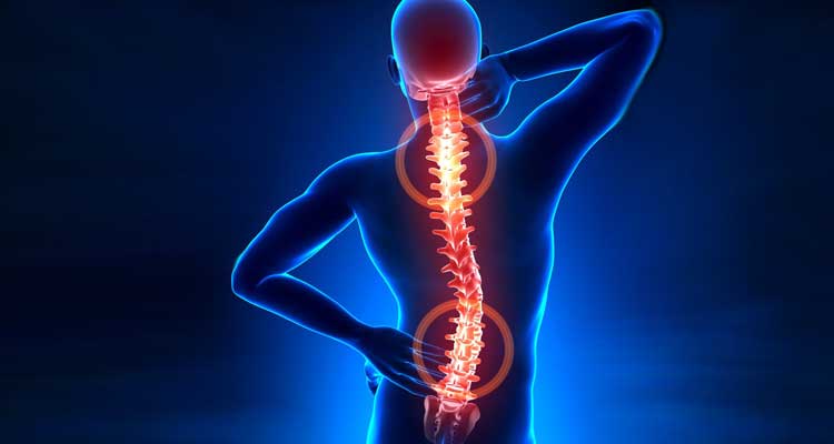 ¿Puede seguir haciendo deporte si tengo hernia discal?