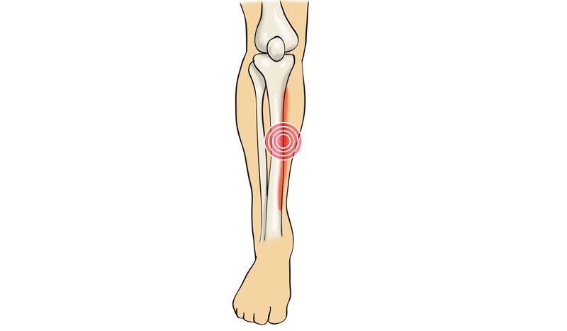 ¿Será periostitis este dolor que tengo en la pierna?