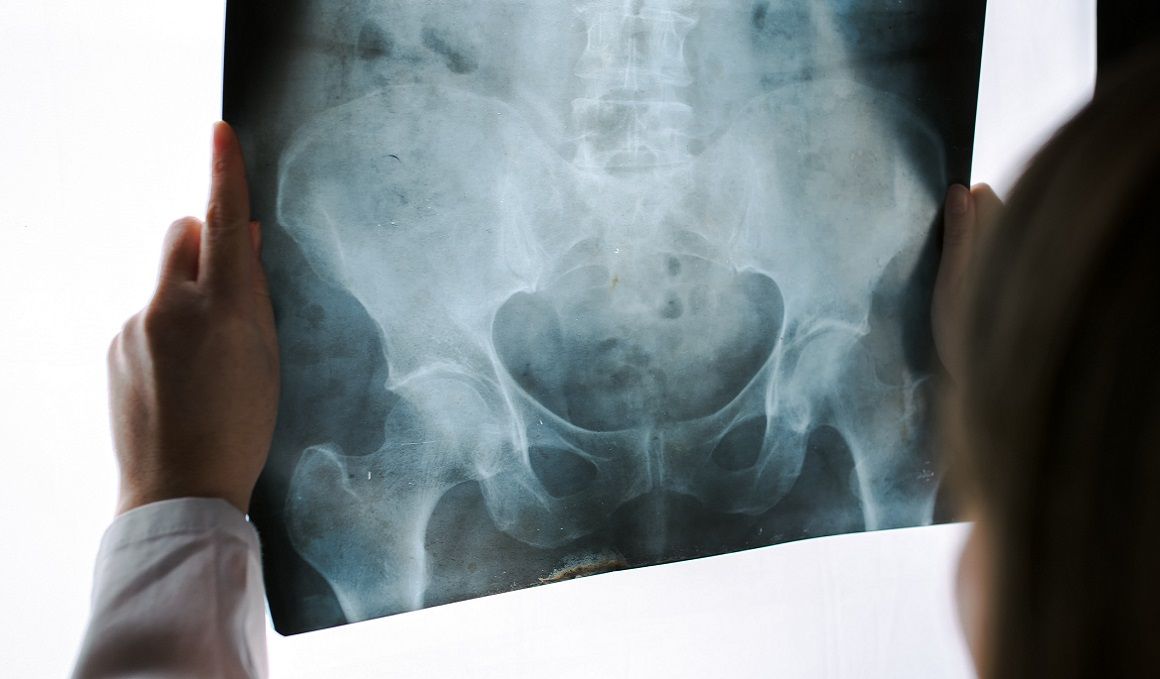 La osteopatía de pubis debe ser tratada por un médico.