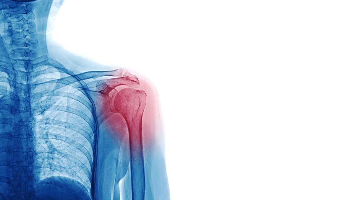 La tendinitis debe curarse para evitar problemas crónicos.